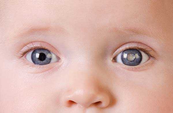 What is a Congenital Cataract?