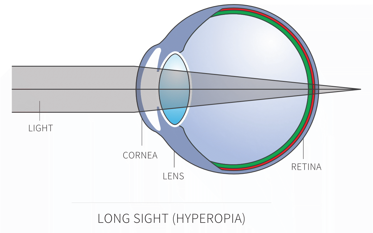 What is Farsighted? | Hypermetropia definition
