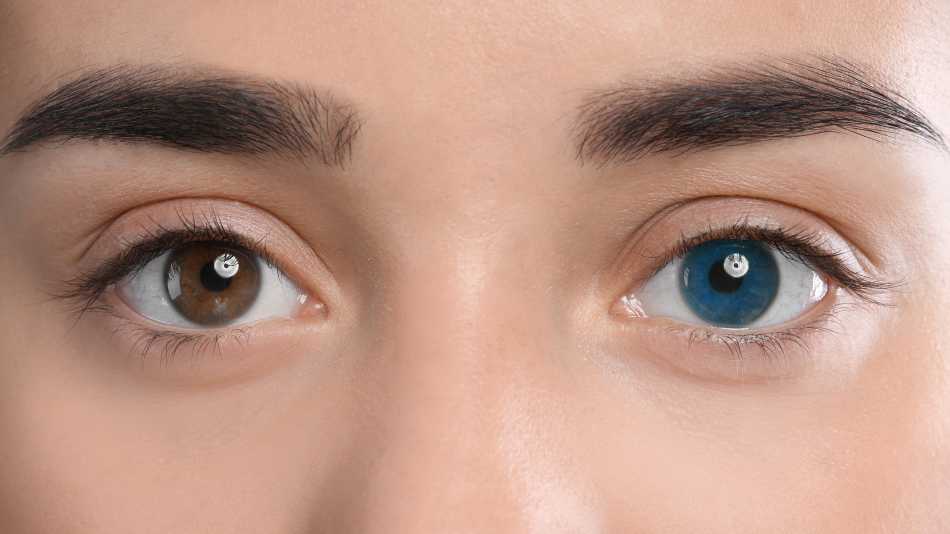 Two Eyes, Two Colours: A Quick Overview Of Heterochromia