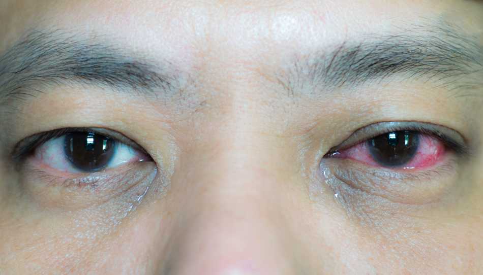 All You Need To Know About Eye Infections