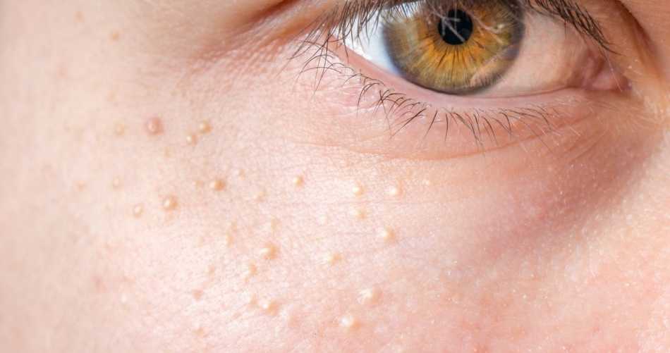 What Are Milia Spots And How To Remove Them?