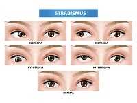 Understanding Strabismus: The Eye Disorder Every Parent Should Know