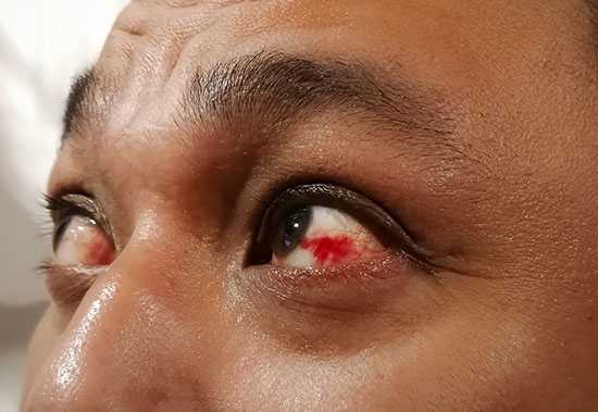 What To Do About Subconjunctival Haemorrhages