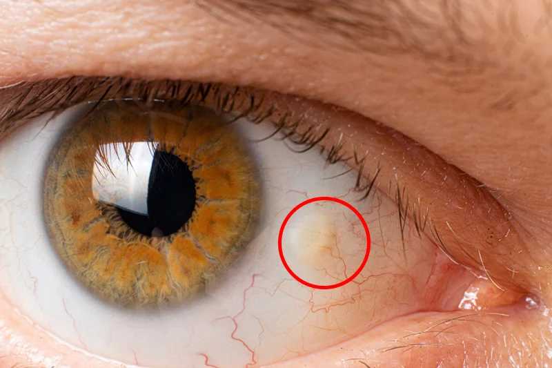 Pingueculae: Are These Yellow “Eye Bumps” Serious?